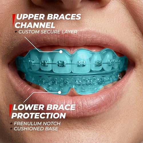 Mouth Guard for Braces - Kids Ages 7-10, Upper & Lower, No-Boil - color: Blue, size: Youth UpTo 10 Year